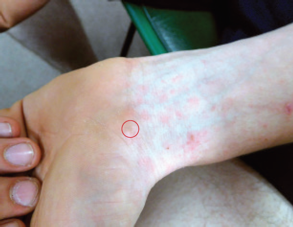 Treating Scabies Infestations In Children And Adults